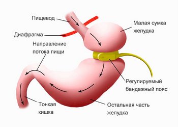 Лапароскопическое бандажирование желудка