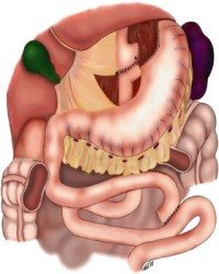 Шунтирование желудка - осложнения после операции