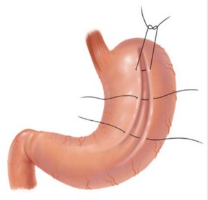 Гастропликация желудка – показания и противопоказания