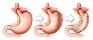 Лапароскопическая гастропликация желудка