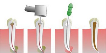 Пломбирование каналов зуба горячей гуттаперчей