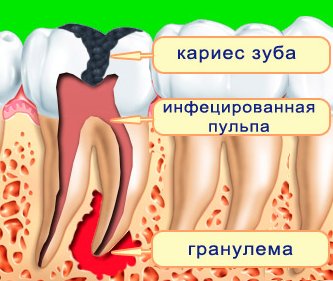 Зубная гранулема