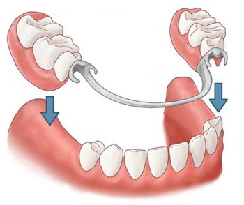Методы протезирования зубов