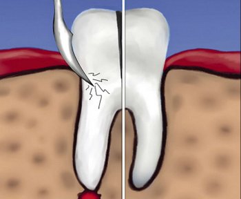 Гемисекция - лечение кисты зуба