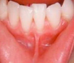 Пластика уздечки нижней губы