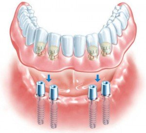 Имплантация зубов all-in-4