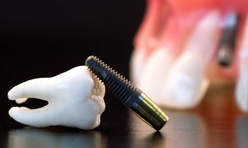 Стабильность зубного импланта