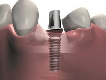 Имплантация зубов при недостатке костной ткани