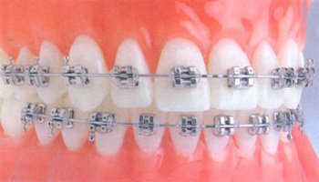 Неправильный прикус и имплантация зубов
