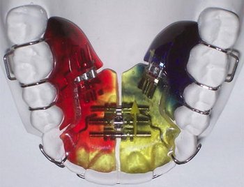 Ортодонтическая пластинка с винтом Бертони