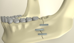 Переломы нижней челюсти