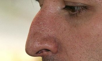 Горбинка на носу - корекция носа