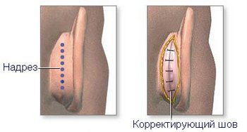 Отопластика - операция отопластики