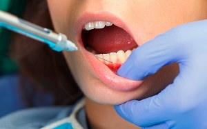 Интралигаментарная анестезия в стоматологии