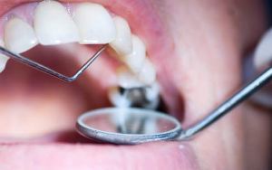 Анестезия в стоматологии - осложнения