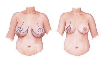 Уменьшение груди - операция уменьшения груди