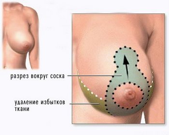 Подтяжка груди - разрезы при подтяжке груди