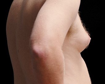 Увеличение груди у мужчин - причины