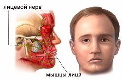 Повреждение лицевого нерва