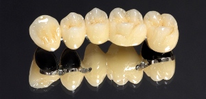 Металлокерамические зубные коронки