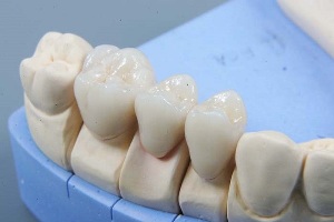 Керамические зубные коронки