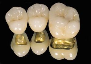 Золотокерамические зубные коронки