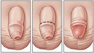 Фимоз - обрезание крайней плоти